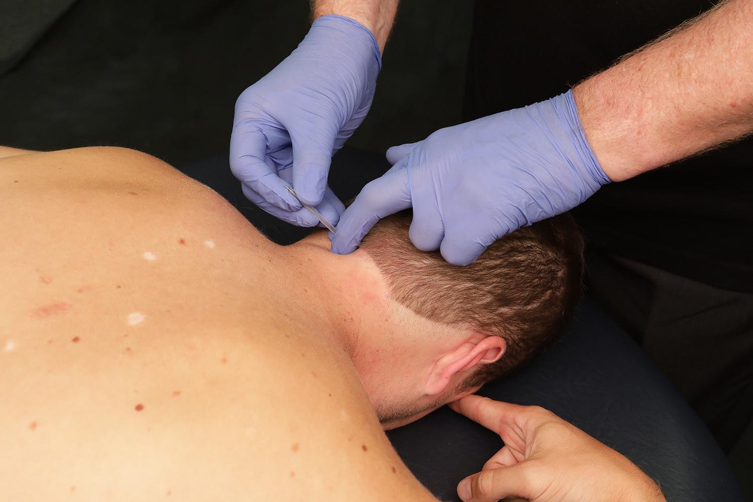 Dry Needling Dubai | Pain Relief | Physio Expert Dubai
